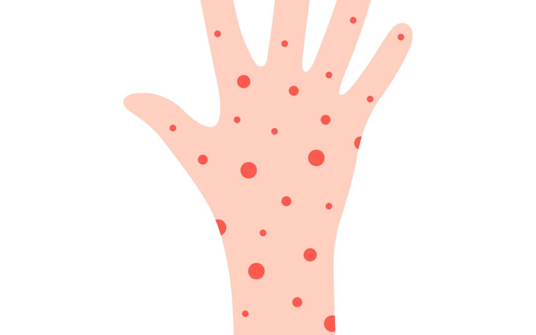 a hand with red bumps on it